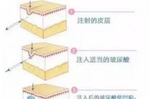 玻尿酸究竟有什么了不起?