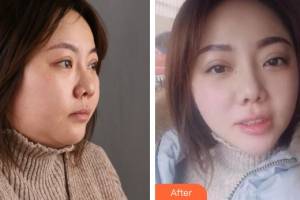 昆明惟美整形医院周静整形价格表附纹眉案例展示