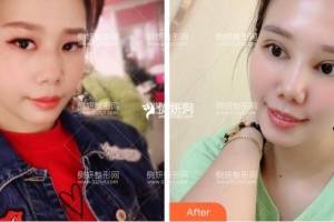 长沙爱思特医疗美容医院张姣姣全切双眼皮怎么样附最新价格表