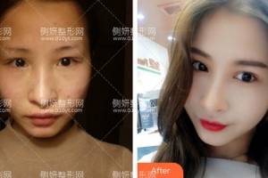 蚌埠人民医院整形美容科田宇虹眼综合怎么样附最新价格表