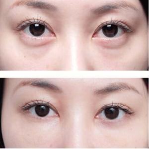 韩国双眼皮和欧洲双眼皮有什么不同?有人能做欧式双眼皮吗?