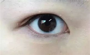 做双眼皮整形手术要多少钱?与双眼皮价格相关的因素有哪些?