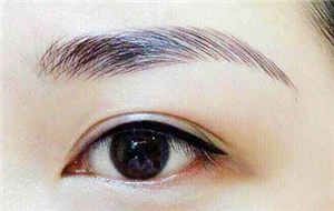 韩国的三点式双眼皮是什么?它的优势是什么?