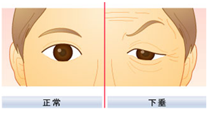 什么是生物焊接双眼皮手术?生物焊接双眼皮手术不好吗?