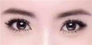 武汉双眼皮手术后好看吗?如果你符合这四个条件,你就应该注意。