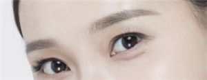 是什么原因造成双眼皮修剪后长期没有恢复或者修复效果不好?