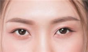 现在割下你的眼皮要多少钱?割双眼皮后悔怎么办?