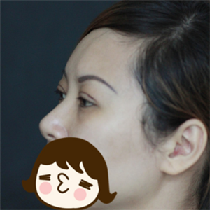 南京割双眼皮留下疤痕怎么办?双眼皮疤痕增生怎么办?