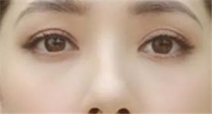 上海隆鼻有哪些后遗症?如何避免隆鼻后遗症?