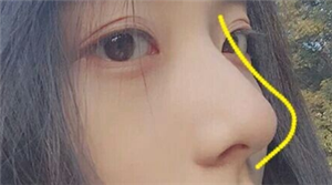 隆鼻手术价格是多少?