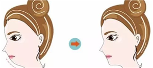 双下巴在一秒钟内变成单下巴,一匹“V”脸的马也会有。