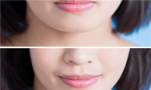 如果咬肌变大怎么办?注射瘦脸的针头效果好吗?