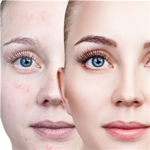 妊娠纹可以去除吗?效果好吗?