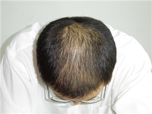 种植后你能染发和烫发吗?