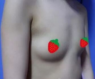 注射隆胸的注意事项有哪些?