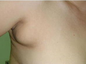 杭州_假体隆胸可以取出一辈子吗?假体隆胸多久可以变软?