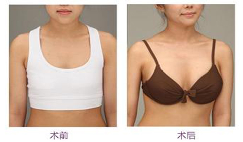 假体隆胸手术有哪些缺点?