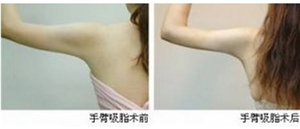 腰美,需要腹部抽脂