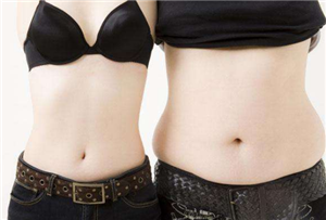 什么时候通过抽脂减肥更合适?