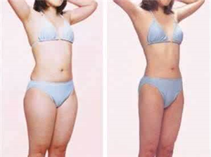 臀部抽脂不仅减肥,还能抬高臀部?!