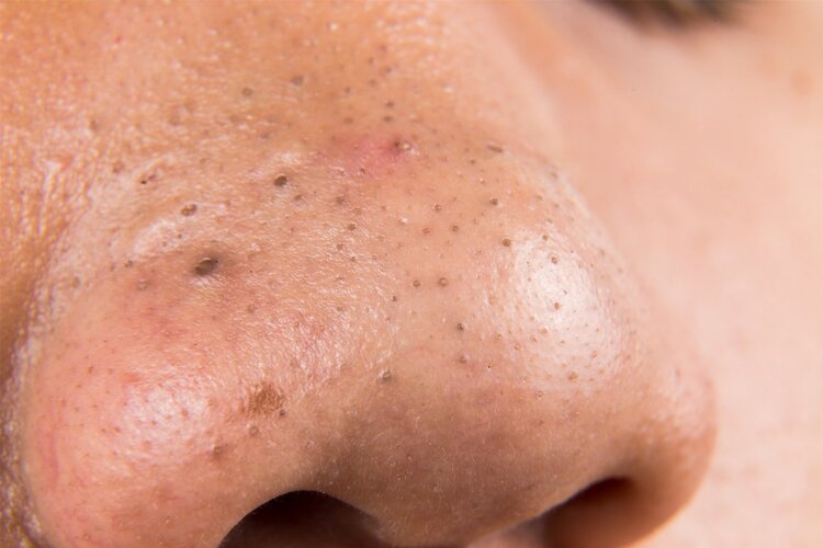 鼻子周围挤出的白色条状物，是螨虫还是粉刺？