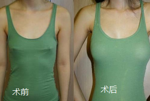 隆胸前后