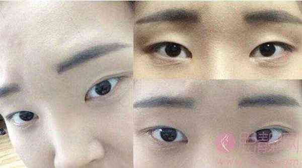 双眼皮手术案例