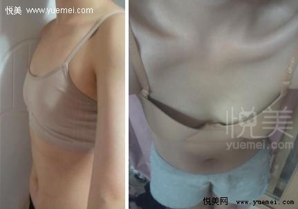 告别平胸360CC让我成为自信女人