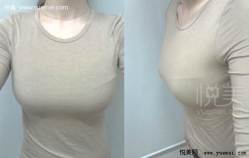 告别平胸360CC让我成为自信女人