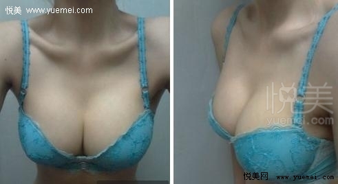 告别平胸360CC让我成为自信女人