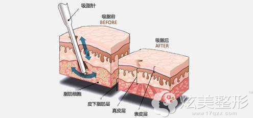 吸脂手术步骤的简易图 吸脂手术步骤的简易图