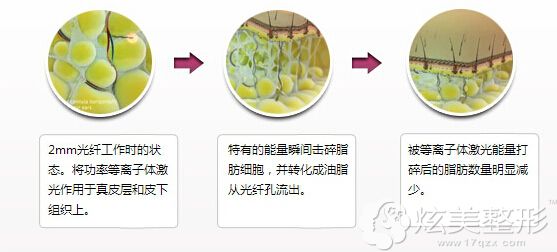 光纤溶脂的手术原理图 光纤溶脂的手术原理图
