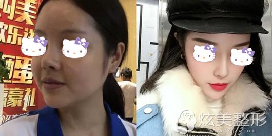 周院长做光纤溶脂瘦脸的真人恢复案例 周院长做光纤溶脂瘦脸的真人恢复案例