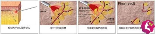 光纤溶脂瘦脸的手术步骤简易图 光纤溶脂瘦脸的手术步骤简易图