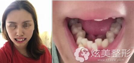 矫正术前牙齿歪斜凌乱 矫正术前牙齿歪斜凌乱