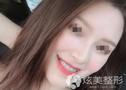 带着金属自锁托槽矫正的牙齿 带着金属自锁托槽矫正的牙齿