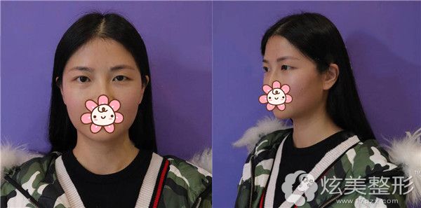 面诊遵义韩美术前一单一双眼睛 面诊遵义韩美术前一单一双眼睛