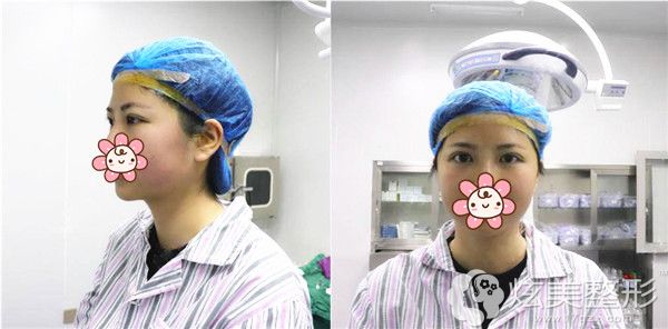 刚做完切开重睑术后效果 刚做完切开重睑术后效果