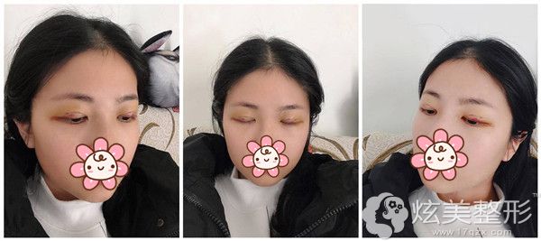 于建涛院长做切开重睑术后恢复中 于建涛院长做切开重睑术后恢复中