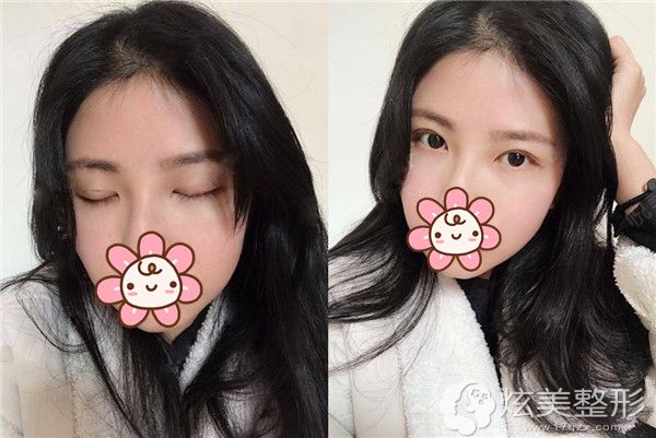 25天切开重睑的恢复情况 25天切开重睑的恢复情况