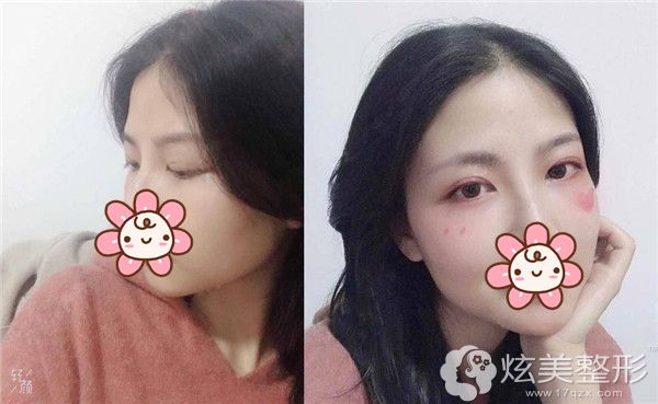 在遵义韩美做切开双眼皮术后半年效果 在遵义韩美做切开双眼皮术后半年效果