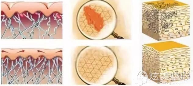 激光祛疤的原理和过程 激光祛疤的原理和过程