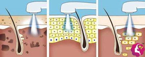 光子嫩肤缩小毛孔手术步骤示意图 光子嫩肤缩小毛孔手术步骤示意图