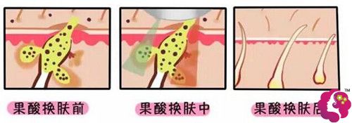 果酸焕肤缩小毛孔原理图 果酸焕肤缩小毛孔原理图