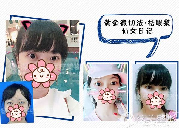 到深圳富华切开双眼皮案例 到深圳富华切开双眼皮案例