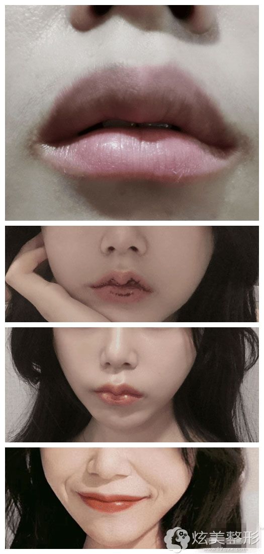 厚唇变薄手术案例过程 厚唇变薄手术案例过程