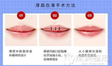 厚唇改薄手术方法 厚唇改薄手术方法