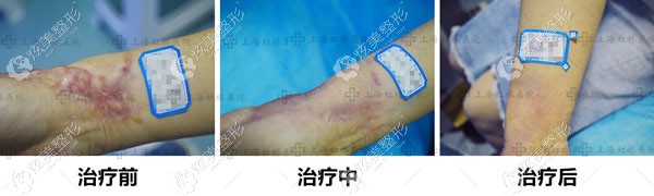 单医生做手腕疤痕修复的恢复图 单医生做手腕疤痕修复的恢复图