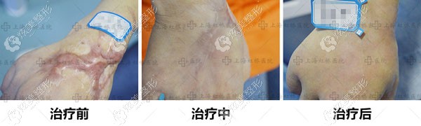 在虹桥医院做疤痕修复的恢复过程 在虹桥医院做疤痕修复的恢复过程