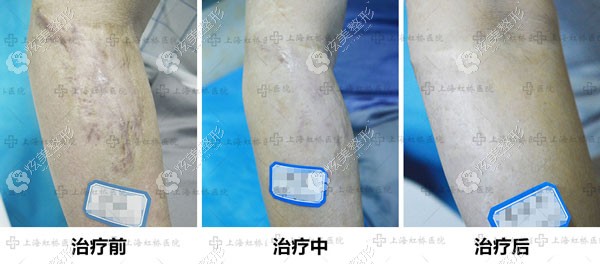单医生做烧伤疤痕修复的对比 单医生做烧伤疤痕修复的对比